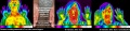 120px-Acupuncture-thermography-monitoring-jose-valdez.jpg