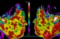 120px-Dental-pain-thermography.jpg