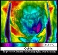 120px-Colitis-medical-thermography.JPG