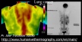 120px-Lung-cancer-thermography-jose-valdez.jpg