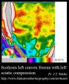 99px-Scoliosis-thermography.jpg