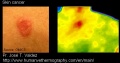 120px-Skin-cancer-thermography-jose-valdez.jpg