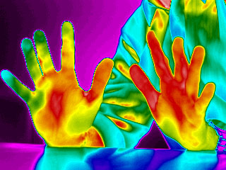 Mains humaines atteintes de sclérose vues en thermographie
