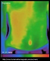 100px-Hepatitis-thermography-jose-valdez.jpg