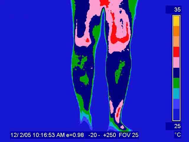 Thermographie de jambes d'un patient souffrand d'atteinte au système nerveux sympathique, corps humain