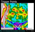 120px-Trigger-points-thermography-valdez.jpg