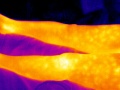 120px-Phlebite-thermographie.jpg
