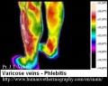 Varicose-veins-flebitis-thermography-jose-valdez.jpg