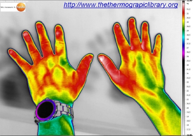 Certaines personnes ont aussi les vaisseaux sanguins de la main plus visibles que d'autres en thermographie