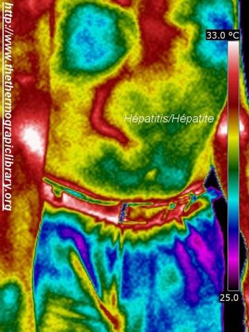 Imagerie thermographique médicale d'une hépatite aiguë