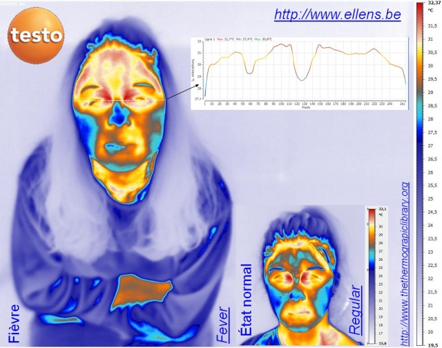 Thermographie médicale infrarouge d'une personne fiévreuse comparée à son état normal
