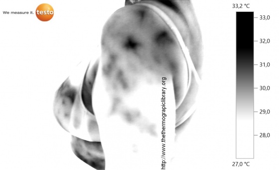 thermographie d'une épaule humaine féminine avec pathologie de blocage