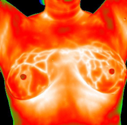 Imagerie thermique d'allaitement par Therma-Scan