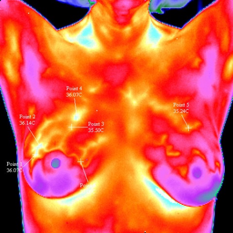 Thermographie d'un cancer du sein, en infrarouges moyens