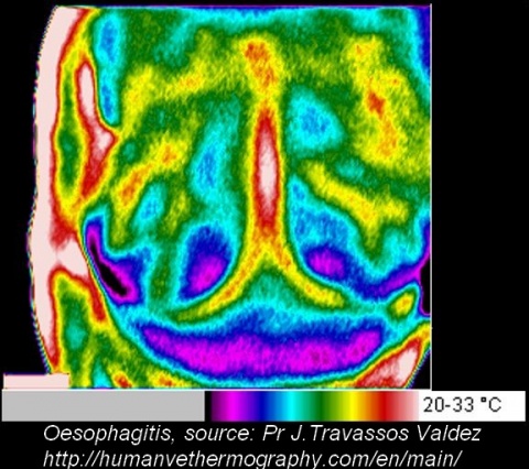 Imagerie thermique d'une œsophagite