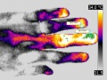 Paronychia-thermography.jpg